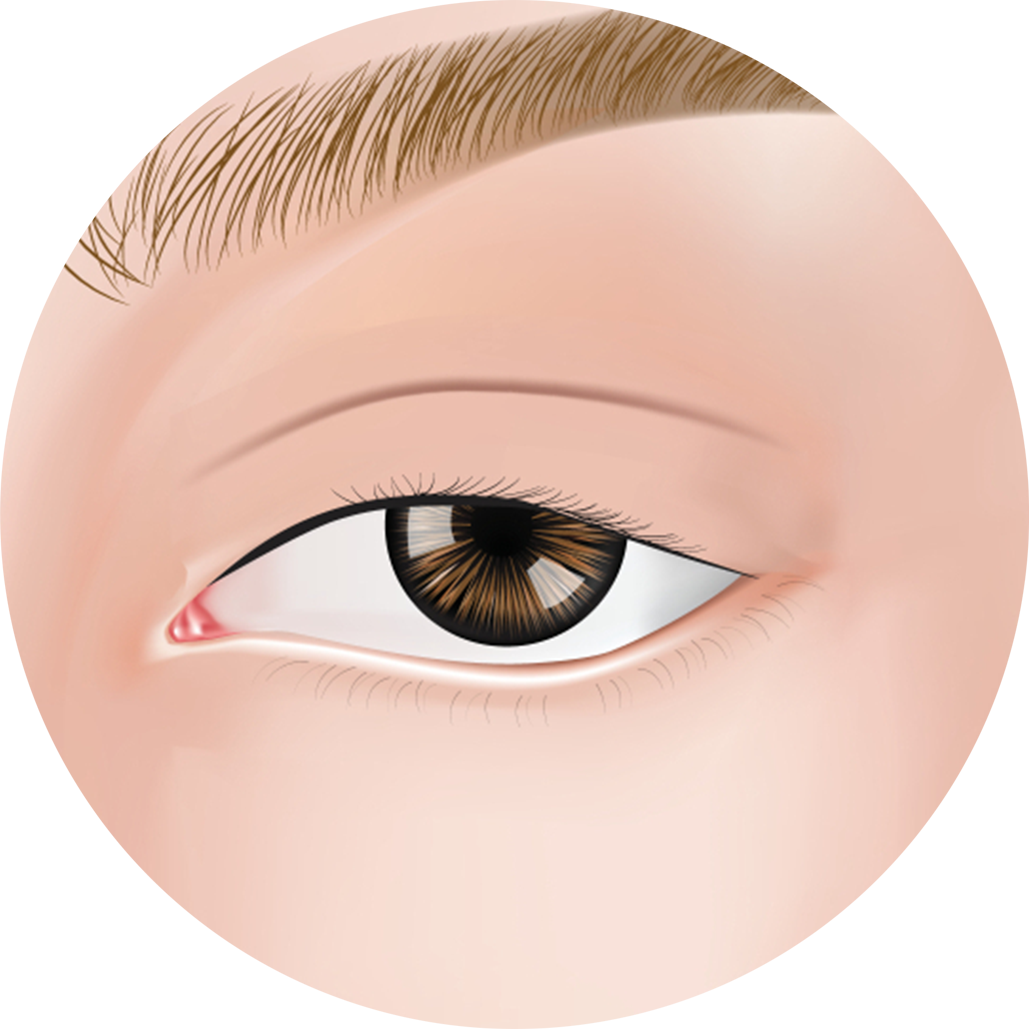 Oculoplasty