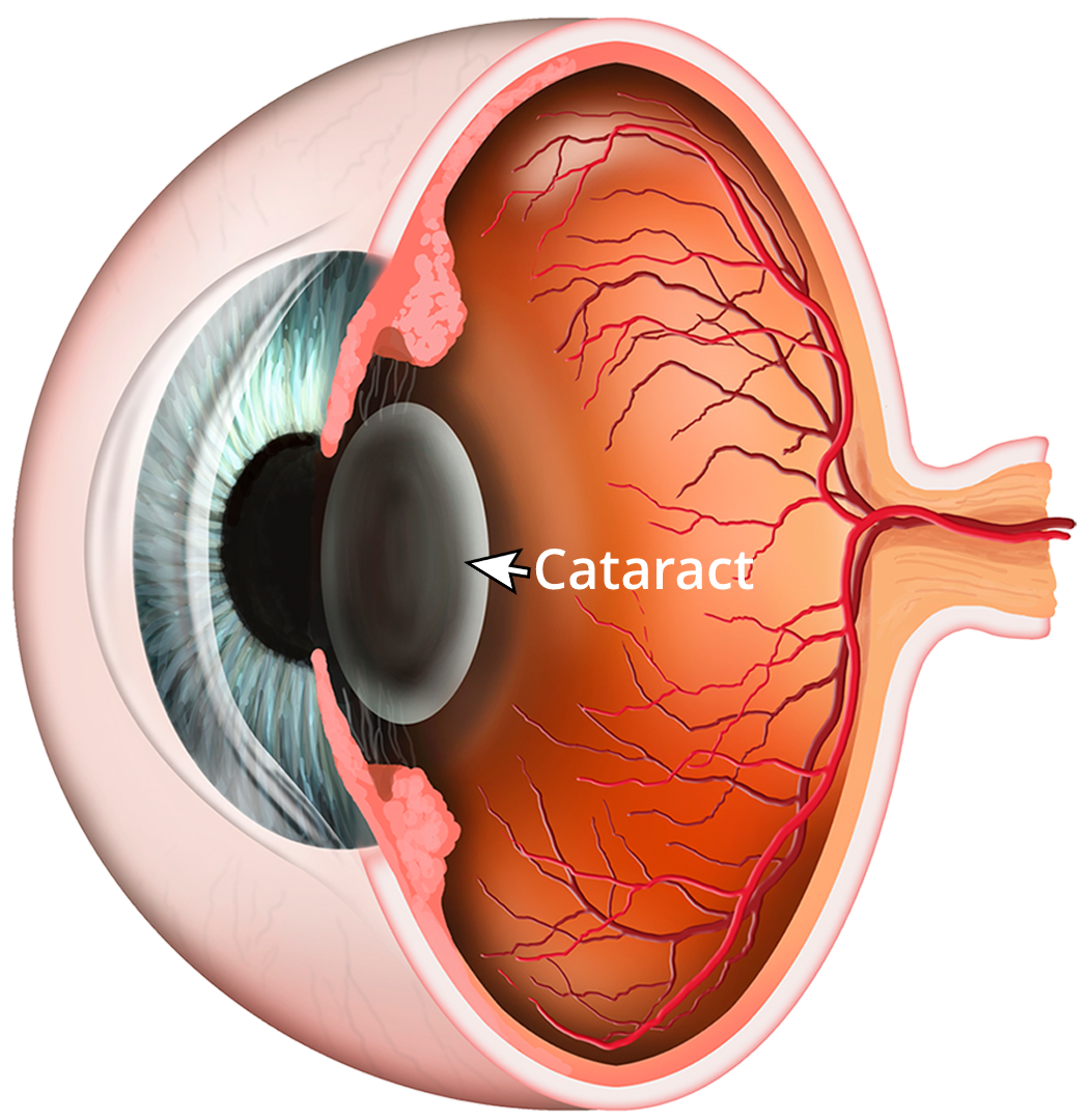 Cataract